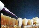 To remove all supragingival calculus.